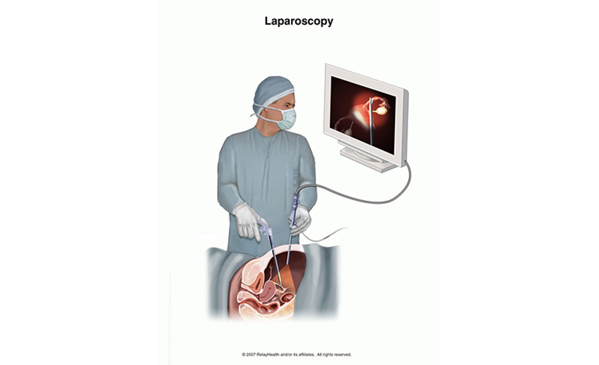 laparoscopy