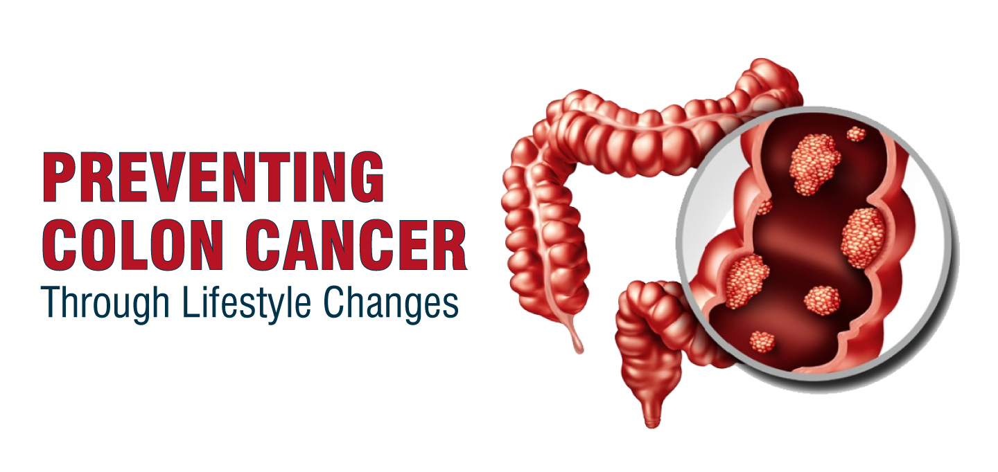 Preventing Colon Cancer through Lifestyle Changes