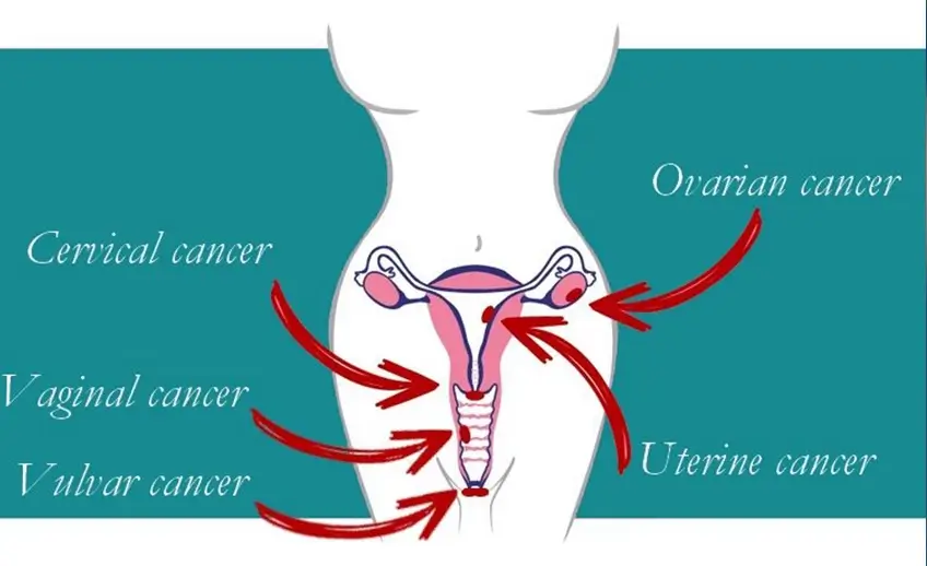 Gynecologic Cancer Surgeon in Ahmedabad