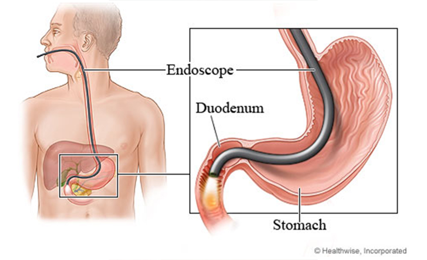 endoscopy
