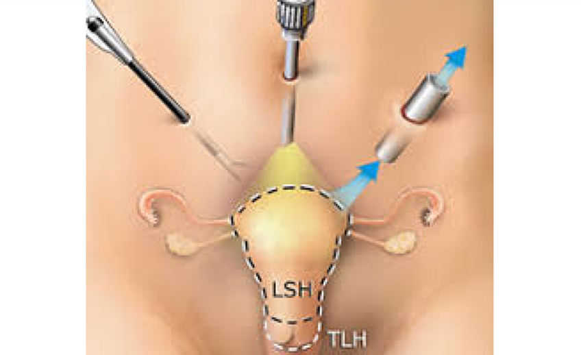 Minimally Invasive Gynecological Surgery Minimally Invasive Gynecological Surgery