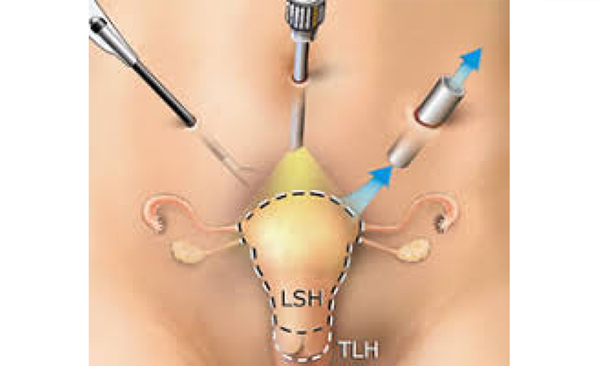 Minimally Invasive Gynecological Surgery